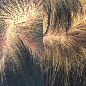 頭皮湿疹 頭皮トラブル 改善方法 りずむヘアデザイン 美容室 土浦市
