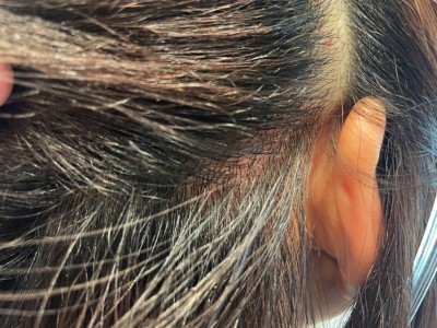 頭皮湿疹　改善方法　皮膚科　土浦市　美容室　りずむヘアデザイン　髪と地肌のクレンジング　